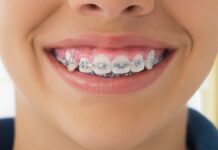 Чому сучасним людям потрібні брекети: історія еволюції та м’якої їжі